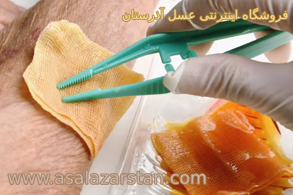چگونگی درمان زخم با عسل